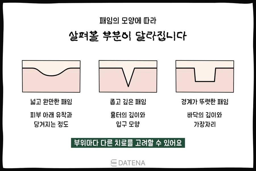 以皮肤截面对比宽而平缓的凹陷、窄而深的凹陷和边界清晰的凹陷的插图