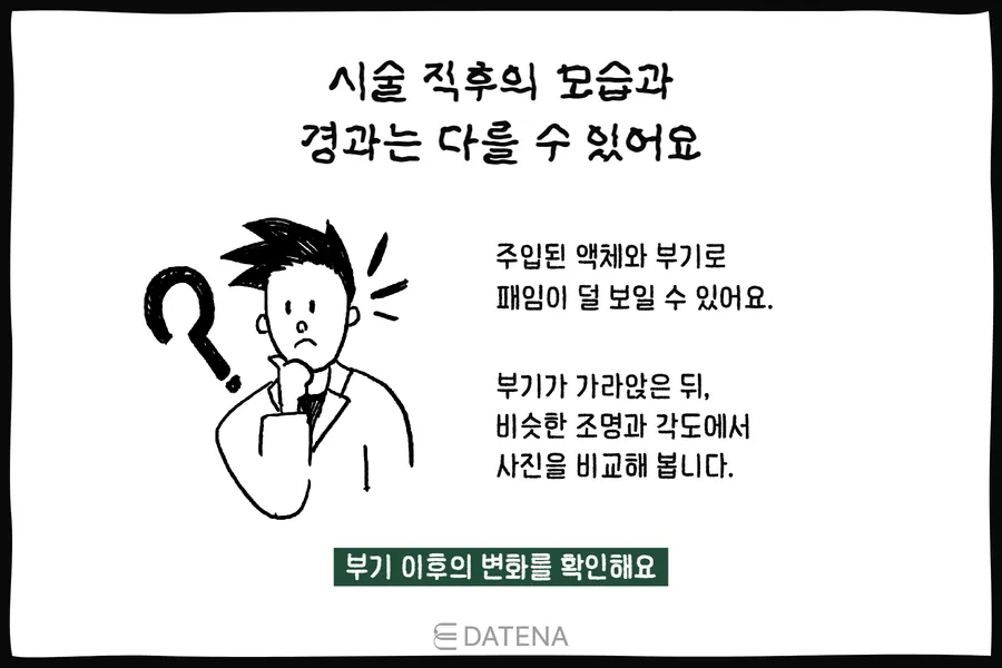 说明治疗刚结束时因肿胀和液体注入,凹陷可能显得不那么明显的人物插图