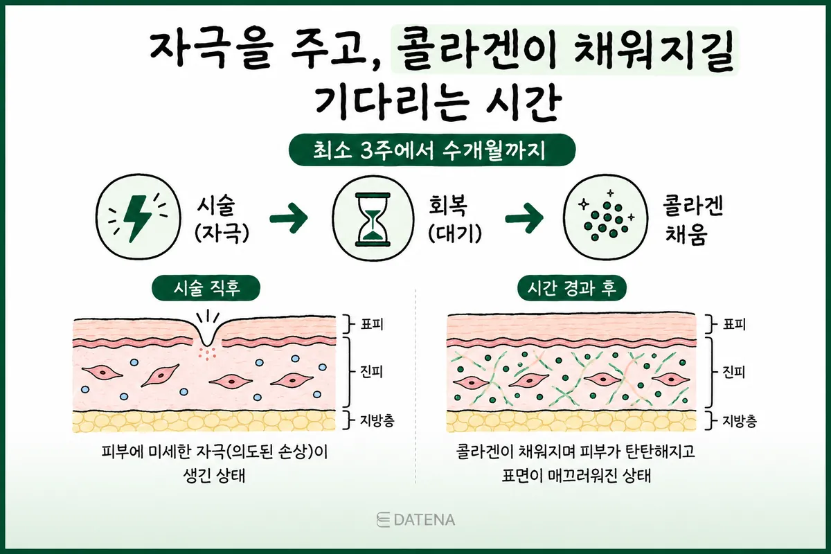 治疗后皮肤从受刺激到恢复、再到胶原蛋白填充过程的皮肤截面示意图