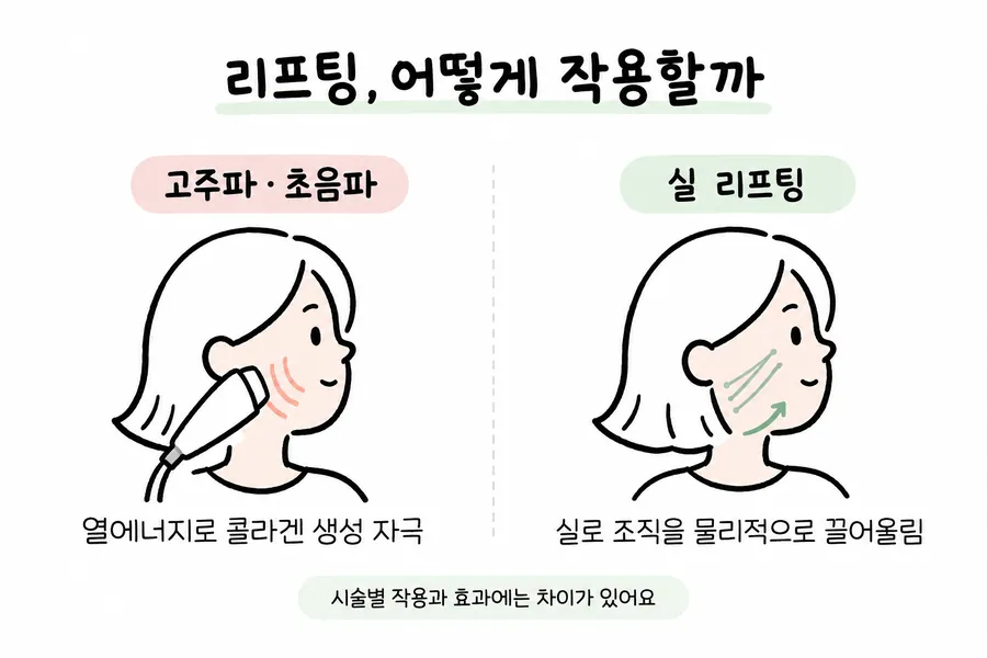 用面部示意图对比射频·超声波提升与线雕提升的作用方式